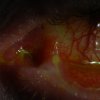 Left Eye - 24 year old male who suffered Toxic Epidermal Necrolysis Syndrome with severe Ocular involvement. Photo was taken 2 years after the initial TEN reaction (2)